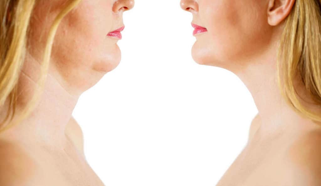 Double Chin treatment Farnham before and after results