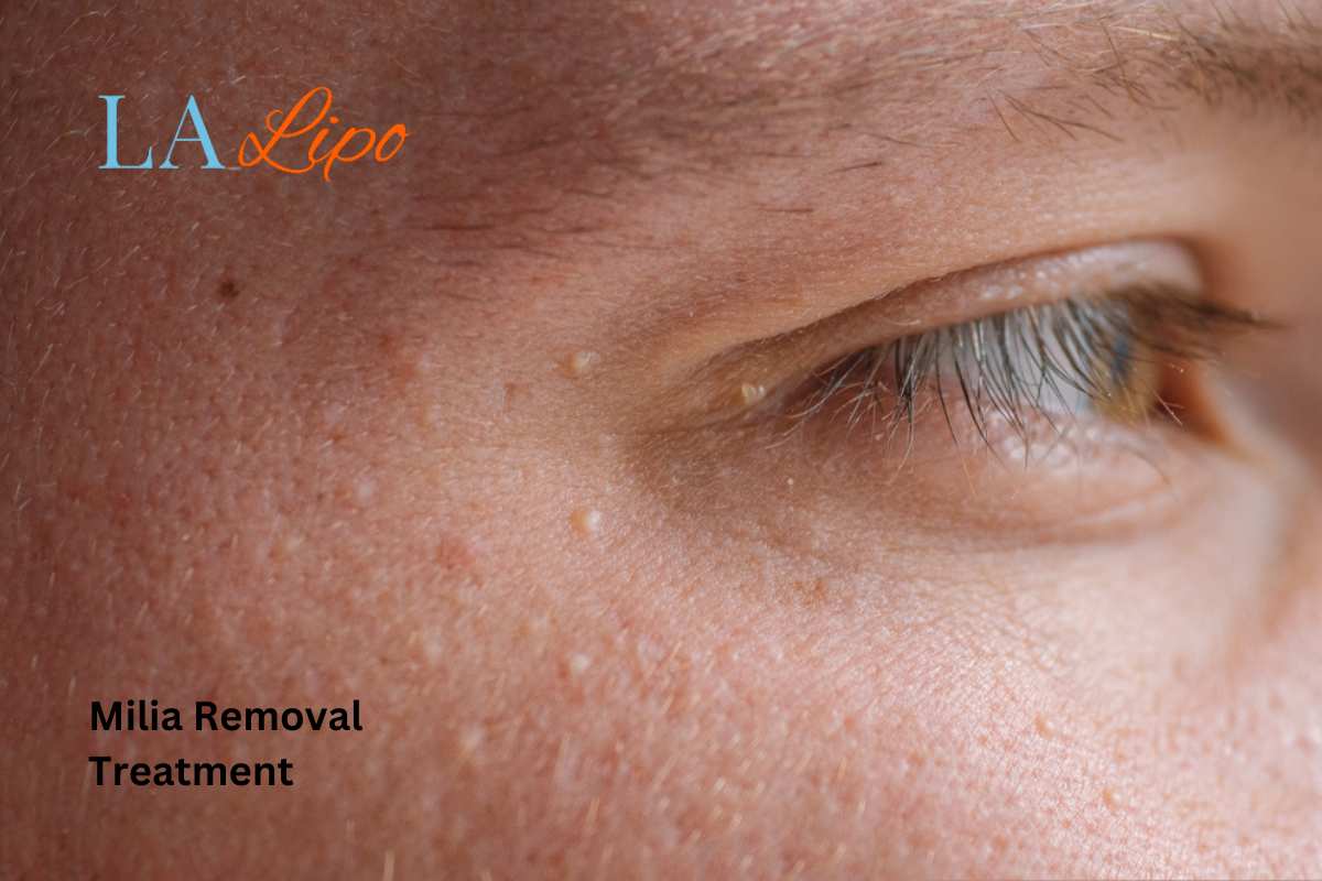 Cryopen Milia Removal: Is It the Easiest and Safest Option Farnham?