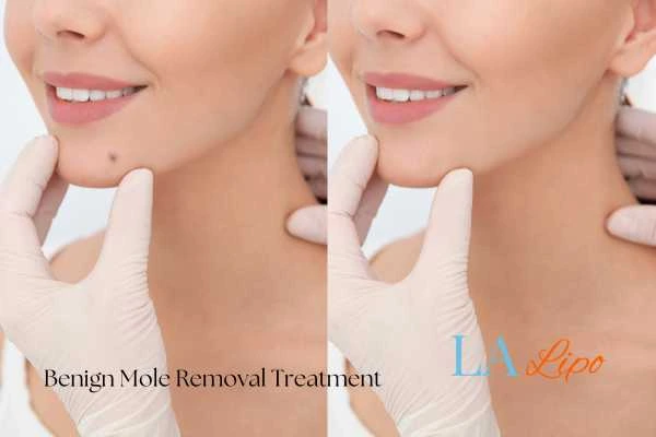 Before-and-after results following benign mole-removal treatment Farnham