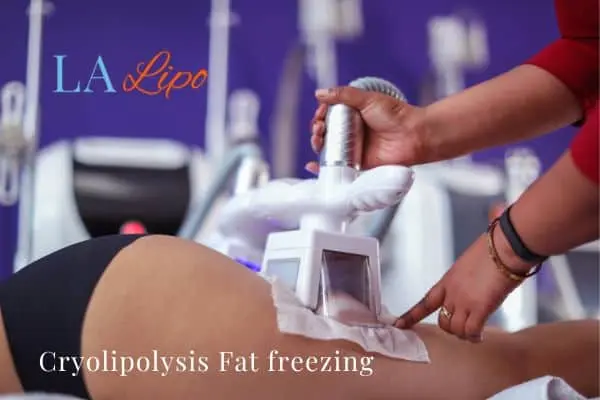 women getting fat freezing Farnham