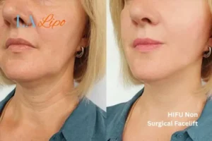 hi-fu for wrinkles Farnham before and after results