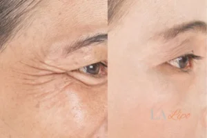 Before and after results of woman - HI-fu wrinkles reduction treatment Farnham