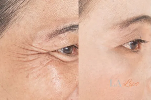 Before and after results of woman - HI-fu wrinkles reduction treatment Farnham