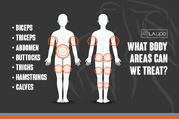 Graphic to show areas you can have LA-EMS Body Sculpting Farnham treatment.