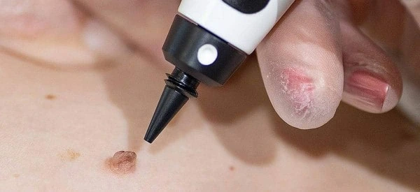 skin tag removal using cryopen Farnham