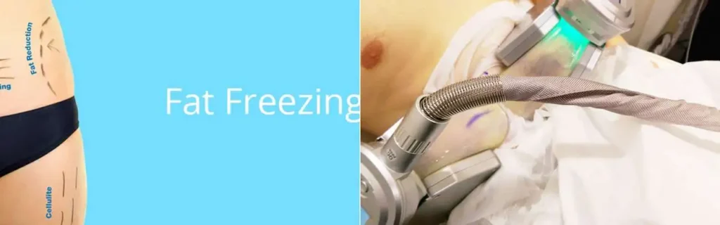Fat freezing Farnham on multiple areas of the body