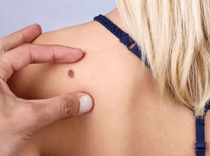 woman having mole removal Farnham consultation before treatment.