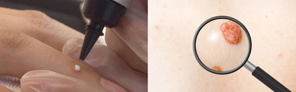 CryoPen practitioner Farnham assessing a benign mole before treatment
