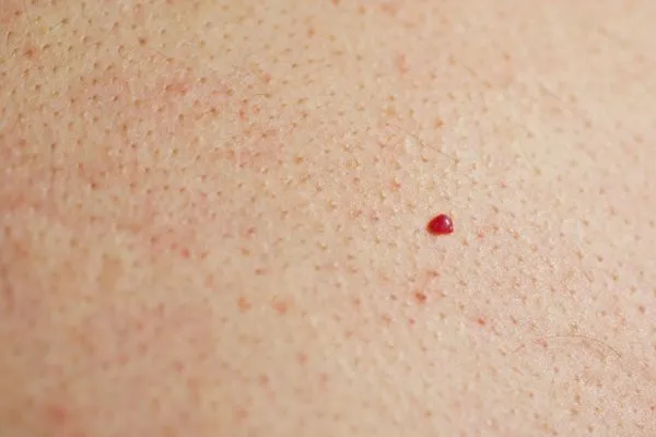 close up of a cherry angioma Farnham