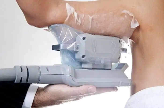 Picture of fat freezing Farnham on the upper arms.