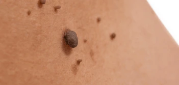 image of a skin tag Farnham