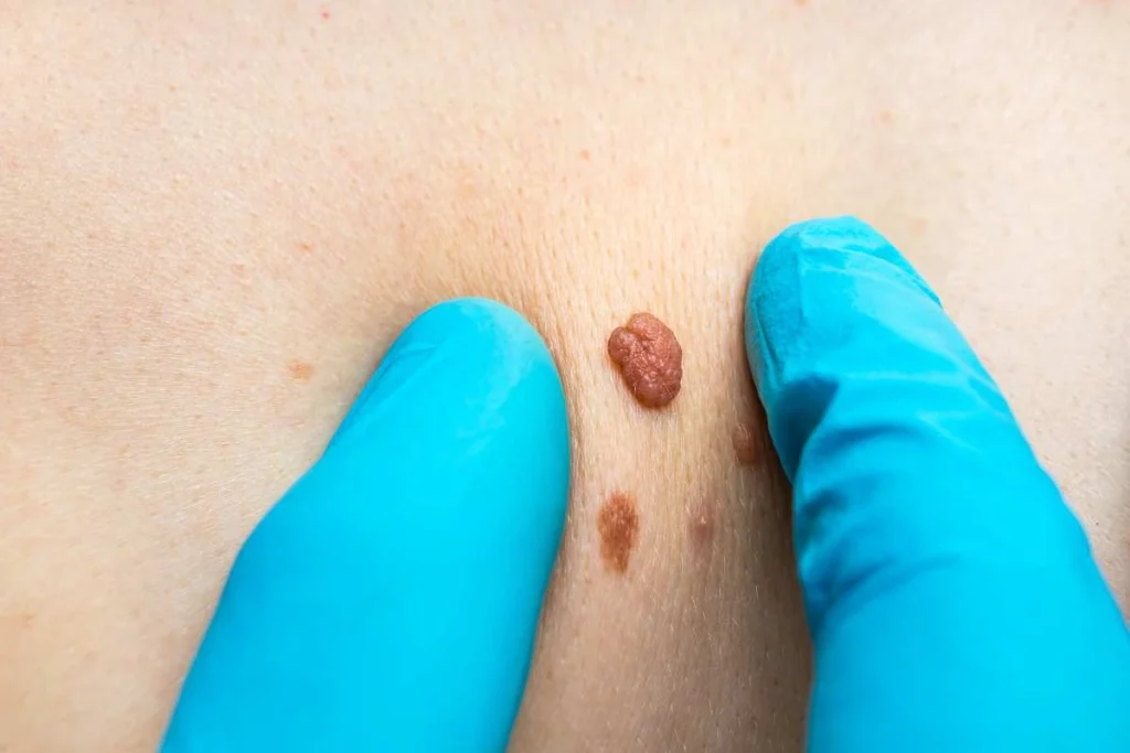 Consultant examining a skin tag Farnham