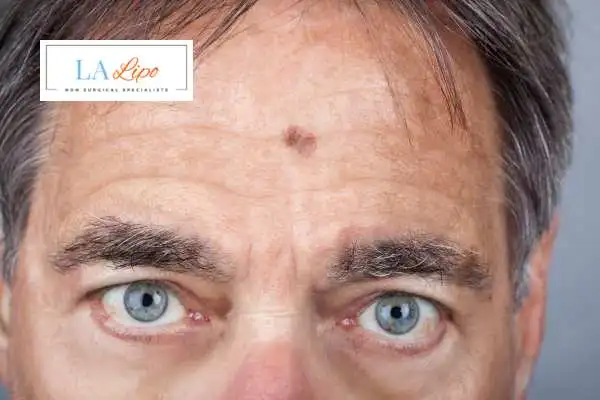Solar Lentigo Removal Farnham image of man with mark on his forehead