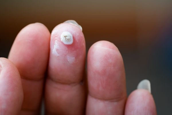 wart on person finger - cryotherapy to treat from LA LIPO Farnham