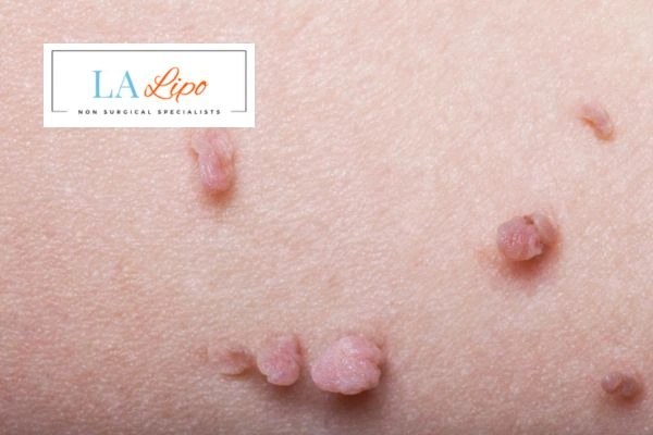 Does cryopen skin tag removal Farnham hurt? Find out now call our team today!