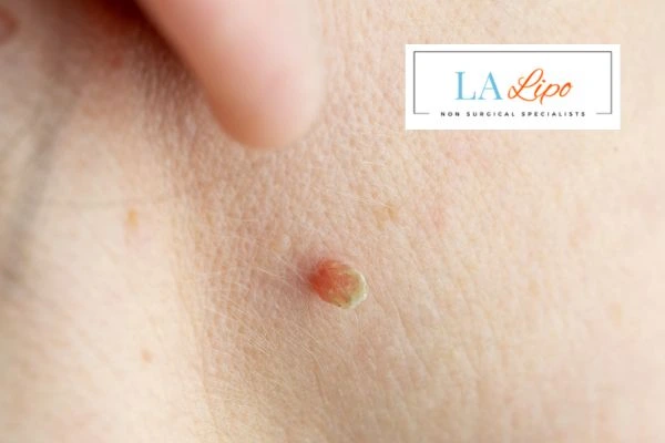Book skin tag removal Farnham today speak to our team now!