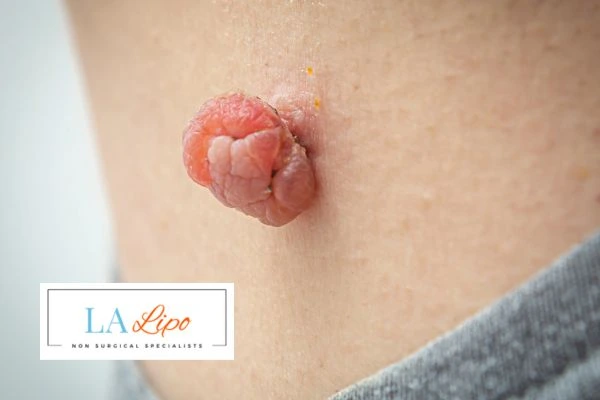 Interested in skin tag removal Farnham? Concerned about the pain? Find out more today!