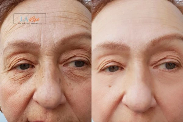 The powerful benefits of Morpheus8 Treatment Farnham - Call Our team today!