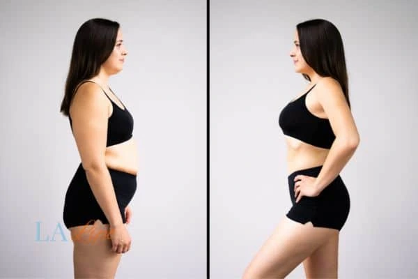 Picture of womans before and after using LA-EMS body sculpting to improve her core strength Farnham