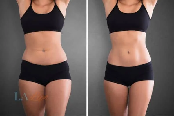 before and after results of non-surgical treatment to help a woman's body image and mental health Farnham