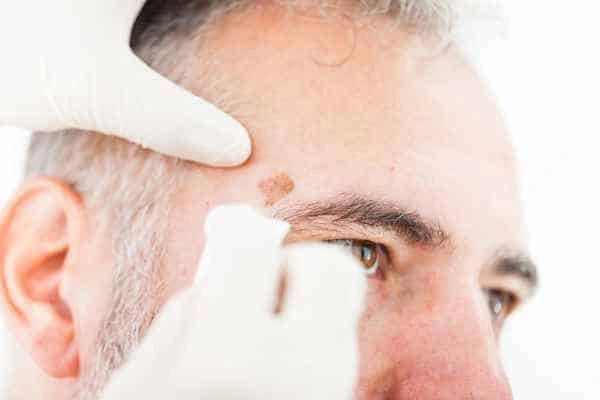 Age spots and elderly people Farnham what is the link?