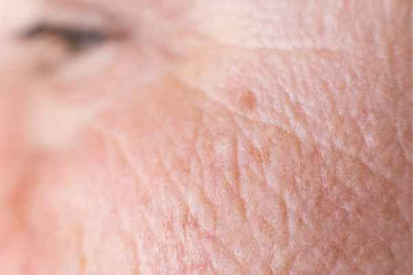 close up picture of a woman's face showing an age spot Farnham