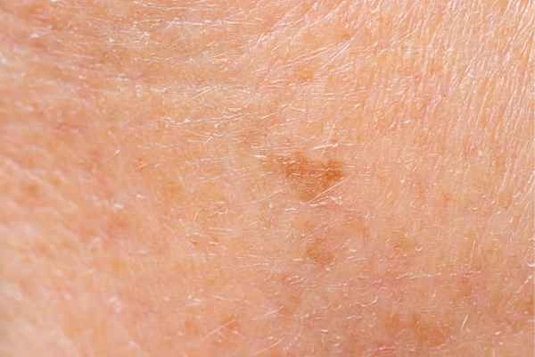 close up picture of age spots Farnham