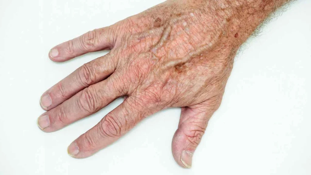 Male hand showing age spot Farnham
