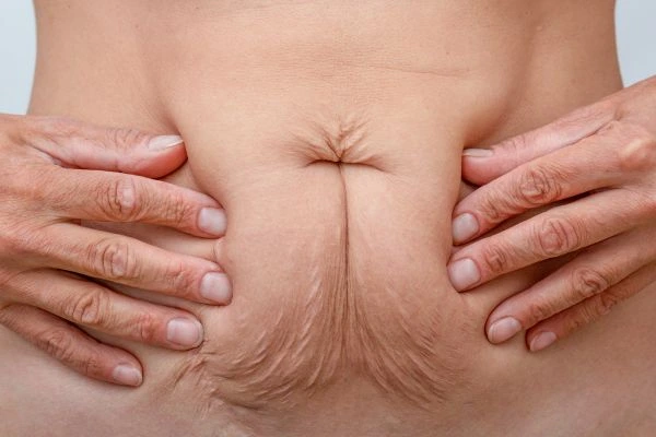 Image of a woman's stomach with loose skin - example of skin tightening Farnham options