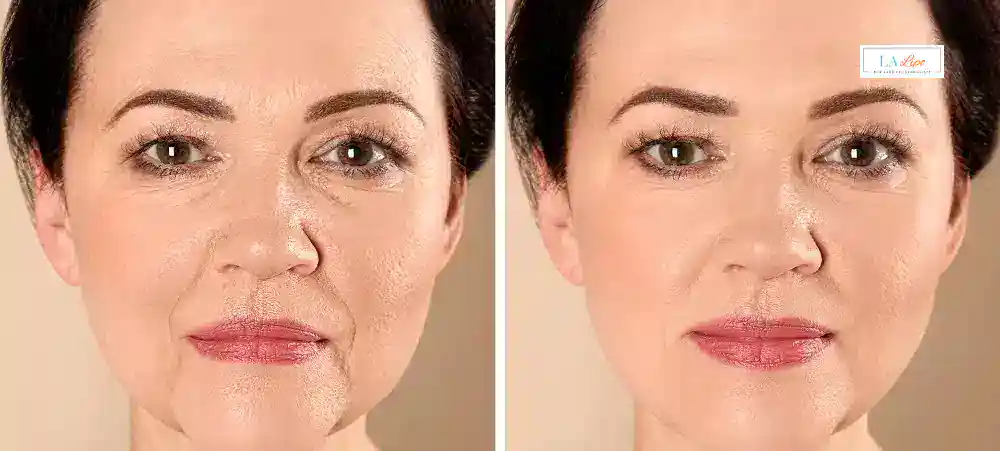How Long Does It Take to See Results and How Long Do They Last Farnham?