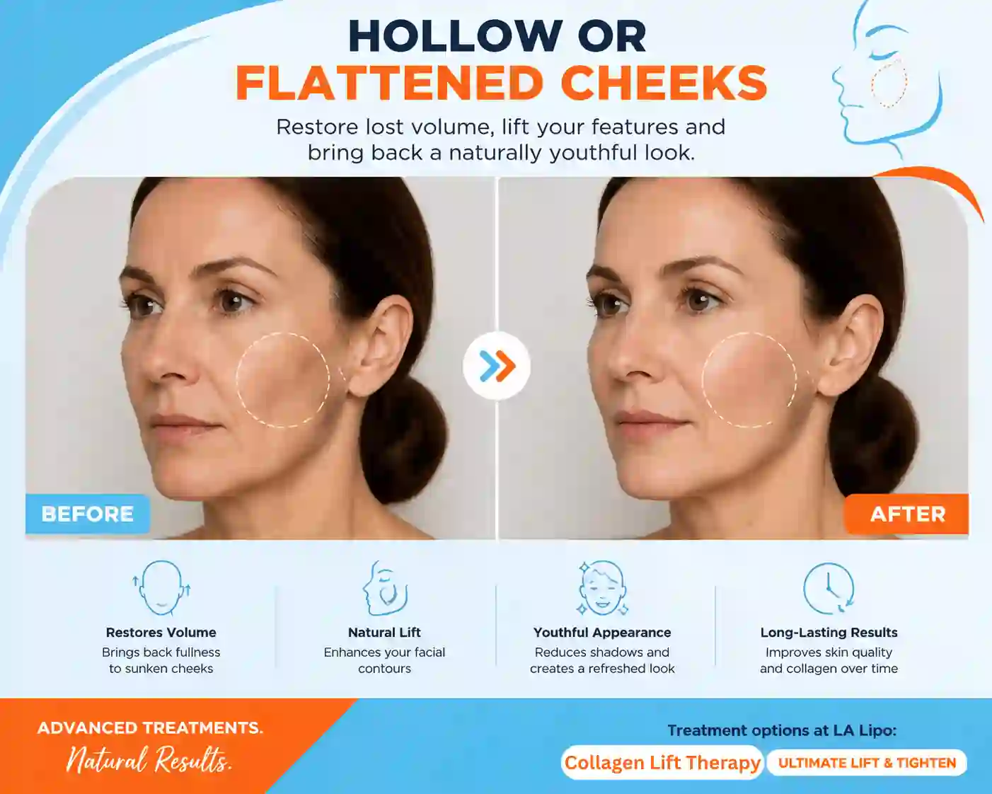 Sign #4: Hollow or Flattened Cheeks Farnham