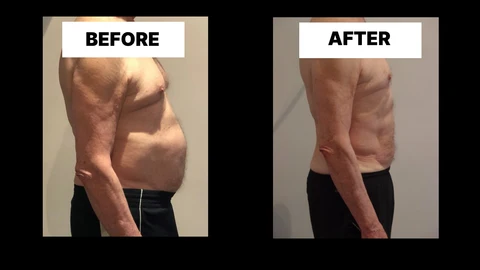 What Symptoms Can Diastasis Recti Cause in Men? Weak Core, Back Pain and Poor Posture Farnham